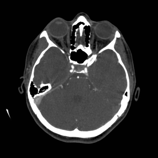 Cerebral venous sinus thrombosis (Radiopaedia 40619-43227 A 73).jpg