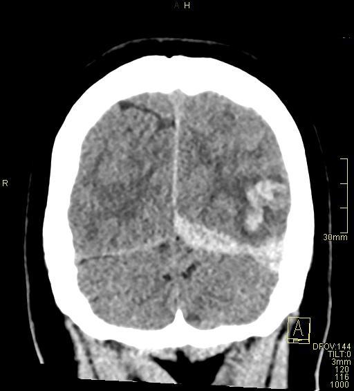 Cerebral venous sinus thrombosis (Radiopaedia 91329-108965 Coronal non-contrast 49).jpg