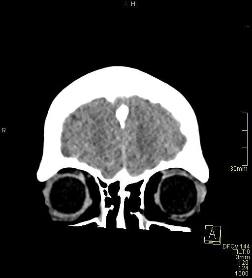 File:Cerebral venous sinus thrombosis (Radiopaedia 91329-108965 Coronal non-contrast 7).jpg