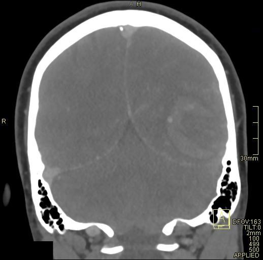 File:Cerebral venous sinus thrombosis (Radiopaedia 91329-108965 Coronal venogram 65).jpg