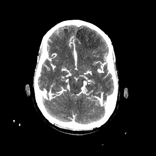 File:Cerebral venous throbmosis - hemorrhagic venous infarction (Radiopaedia 87318-103613 B 15).jpg