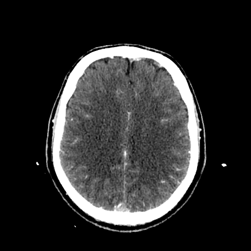 File:Cerebral venous thrombosis (CVT) (Radiopaedia 77524-89685 Axial with contrast 25).jpg