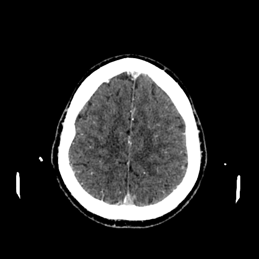 File:Cerebral venous thrombosis (CVT) (Radiopaedia 77524-89685 Axial with contrast 30).jpg