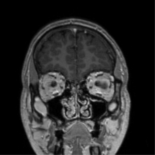 Cerebral venous thrombosis (Radiopaedia 38392-40469 Coronal T1 C+ 75).png