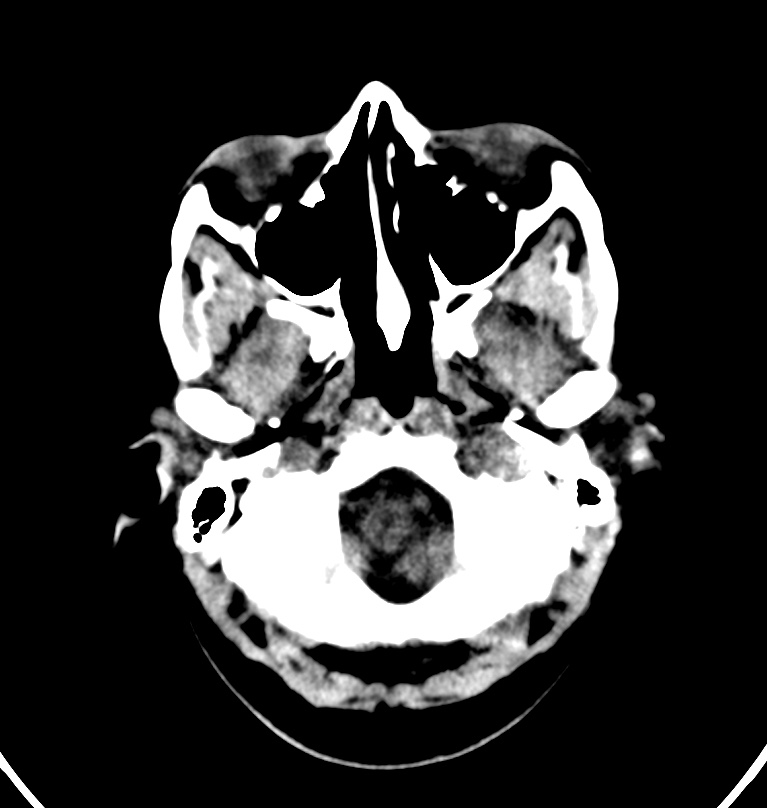 Cerebral venous thrombosis - CT only (Radiopaedia 41031-43778 Axial non-contrast 79).jpg