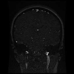 Cerebral venous thrombosis - ulcerative colitis (Radiopaedia 66049-75219 Coronal MRV 53).jpg