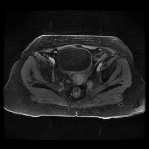 Cervical carcinoma (Radiopaedia 70924-81132 Axial T1 C+ fat sat 228).jpg