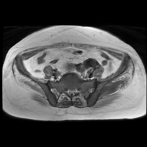 File:Cervical carcinoma (Radiopaedia 88010-104555 Axial T1 4).jpg