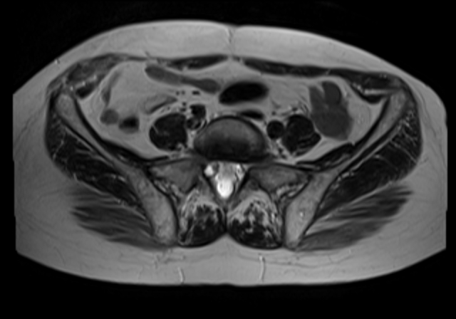 File:Cervical carcinoma (Radiopaedia 88312-104943 Sagittal T1 4).jpg
