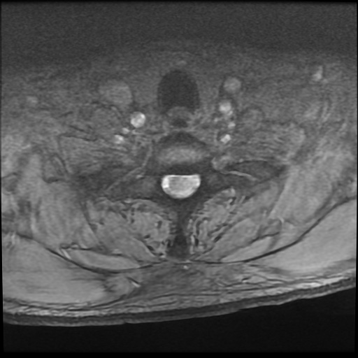 Cervical disc extrusion (Radiopaedia 59074-66364 F 57).jpg