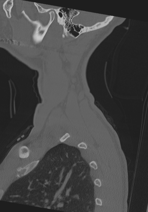 Cervical intercalary bone (Radiopaedia 35211-36748 Sagittal bone window 76).png