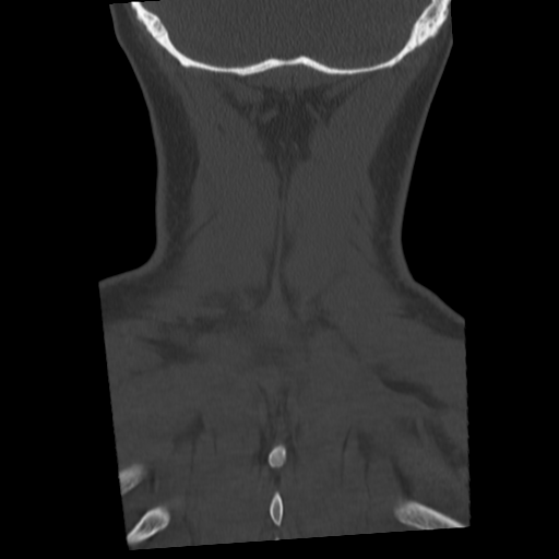 Cervical schwannoma (Radiopaedia 57979-64974 Coronal bone window 51).png