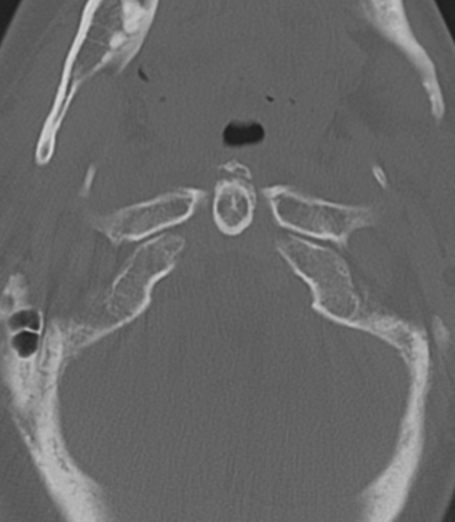 File:Cervical spine fractures with vertebral artery dissection (Radiopaedia 53296-59268 Axial bone window 11).png