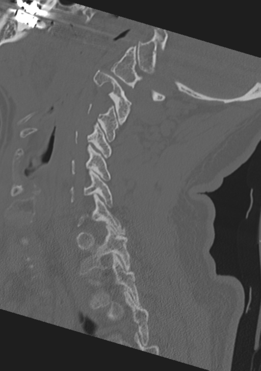 Cervical spine fractures with vertebral artery dissection (Radiopaedia 53296-59268 Sagittal bone window 23).png