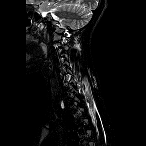 File:Cervical spine posterior ligamentous complex rupture (Radiopaedia 63486-72103 Sagittal STIR 11).jpg