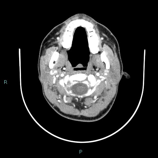 Cervical thymic cyst (Radiopaedia 88632-105335 B 91).jpg