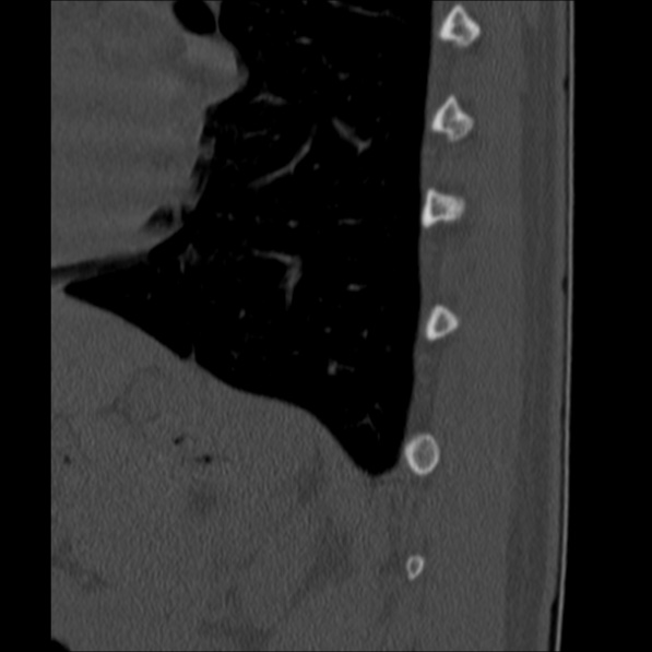 Chance fracture (Radiopaedia 36521-38081 Sagittal bone window 66).jpg