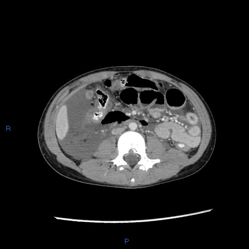 File:Chance fracture with duodenal and pancreatic lacerations (Radiopaedia 43477-46864 A 22).jpg