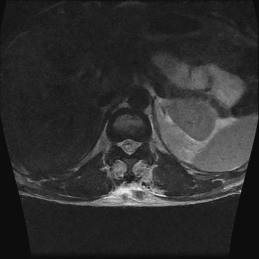 File:Chance type fracture (Radiopaedia 31020-31725 Axial T2 19).jpg