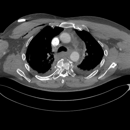 File:Chest multitrauma - aortic injury (Radiopaedia 34708-36147 A 107).png