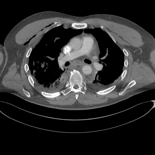 File:Chest multitrauma - aortic injury (Radiopaedia 34708-36147 A 135).png