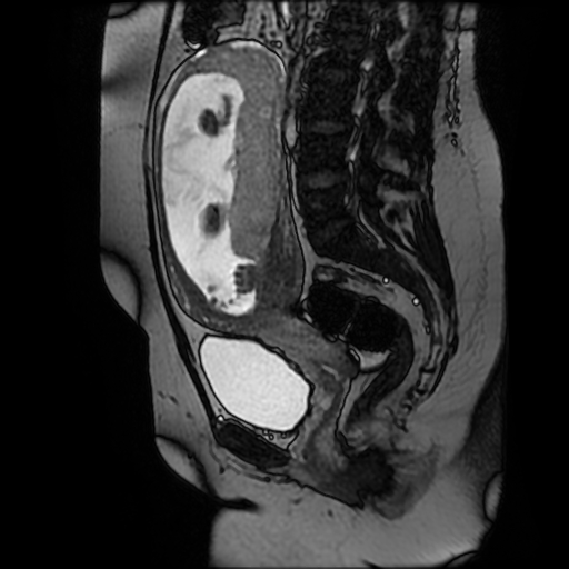 Chiari II malformation - fetal MRI (Radiopaedia 68099-77581 Sagittal Fiesta 32).jpg