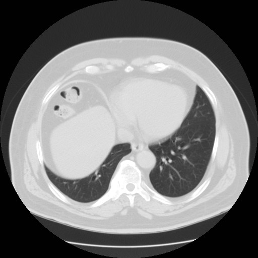 File:Chilaiditi’s syndrome (Radiopaedia 27550-27756 Axial lung window 12).jpg