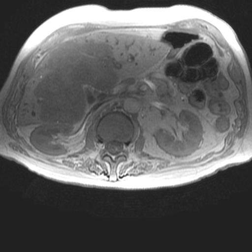 File:Cholangiocarcinoma - mass-forming pattern (Radiopaedia 16017-15677 T1 in-phase 17).jpg