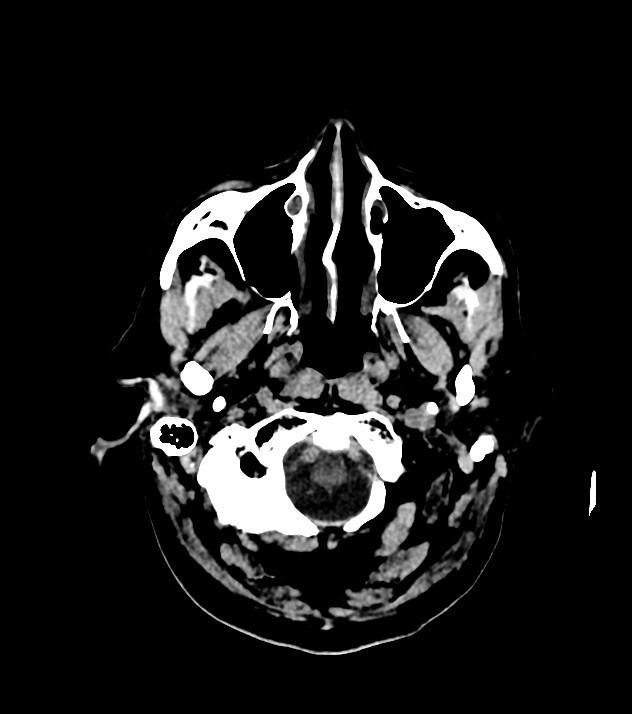 Cholangiocarcinoma with cerebral metastases (Radiopaedia 83519-98628 Axial non-contrast 11).jpg