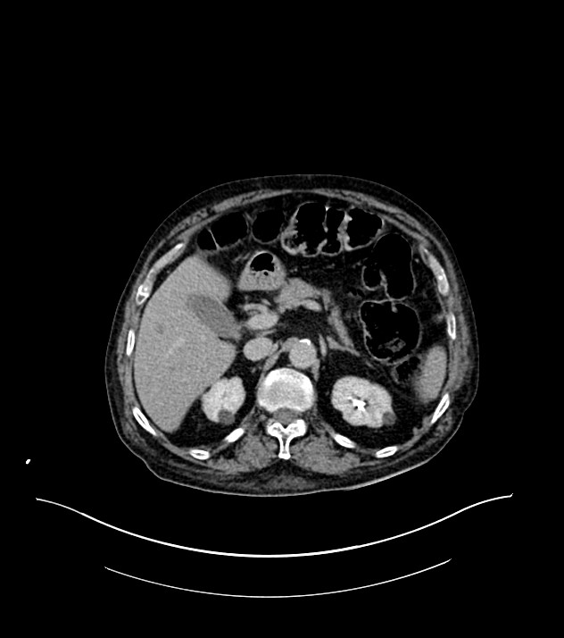 Cholangiocarcinoma with cerebral metastases (Radiopaedia 83519-98629 Axial C+ delayed 33).jpg