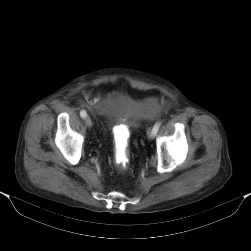 File:Cholangitis and abscess formation in a patient with cholangiocarcinoma (Radiopaedia 21194-21100 A 44).jpg