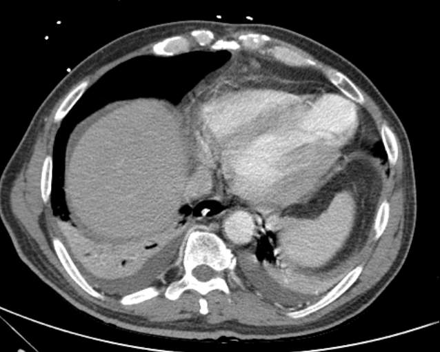 File:Cholecystitis - perforated gallbladder (Radiopaedia 57038-63916 A 11).jpg