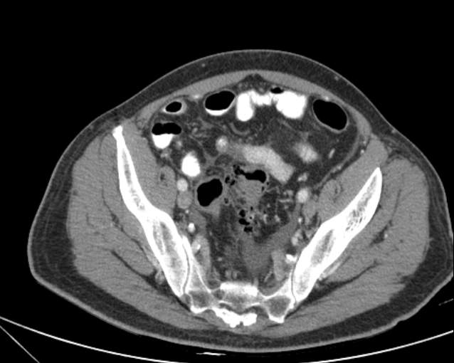 Cholecystitis - perforated gallbladder (Radiopaedia 57038-63916 A 68).jpg