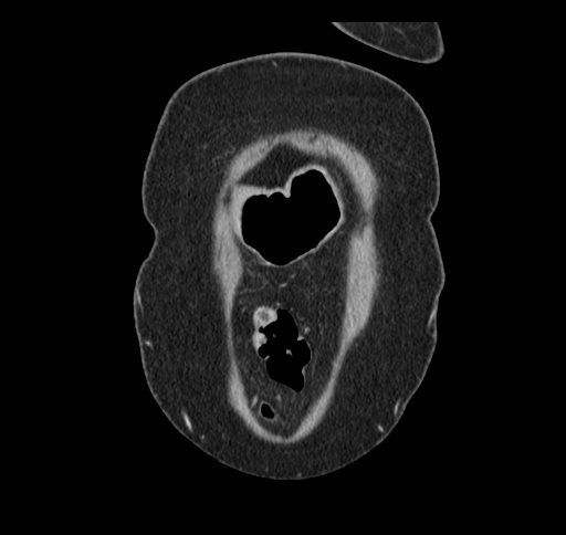 Cholecystoduodenal fistula (Radiopaedia 48959-54022 B 15).jpg