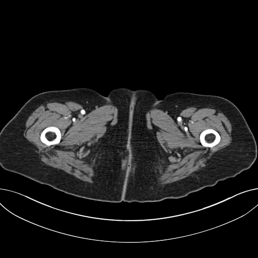 Cholecystoduodenal fistula due to calculous cholecystitis with gallstone migration (Radiopaedia 86875-103077 A 85).jpg