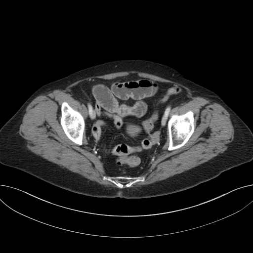 Cholecystoduodenal fistula due to calculous cholecystitis with gallstone migration (Radiopaedia 86875-103077 D 70).jpg