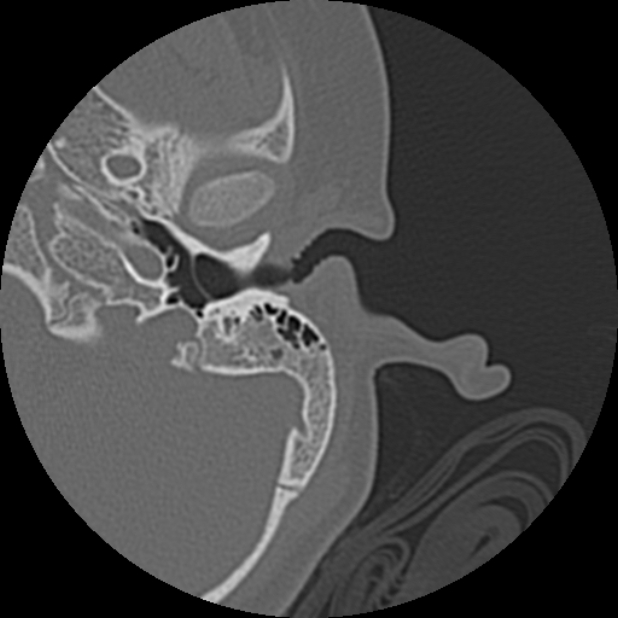Cholesteatoma (Radiopaedia 73023-83750 Axial Left ear 19).jpg