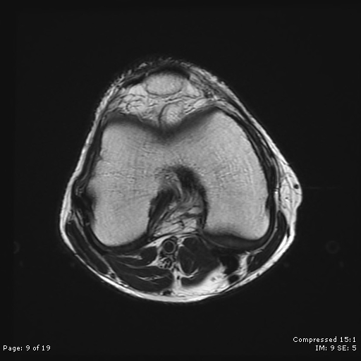 File:Chondroblastoma (Radiopaedia 25725-25891 Axial T2 9).jpg