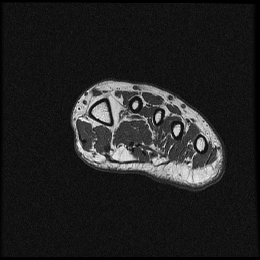 File:Chondroblastoma - midfoot (Radiopaedia 64831-73765 Short axis T1 24).jpg