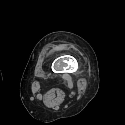 File:Chondrosarcoma - femur (Radiopaedia 64187-72954 Axial non-contrast 23).jpg