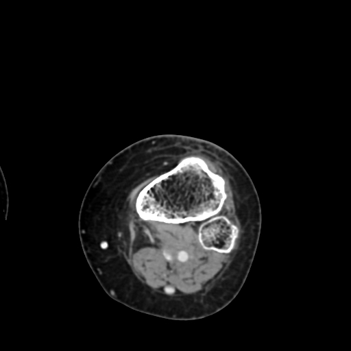 File:Chondrosarcoma - femur (Radiopaedia 64187-72954 Axial with contrast 72).jpg