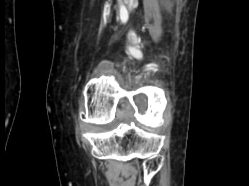 Chondrosarcoma - femur (Radiopaedia 64187-72954 C 38).jpg