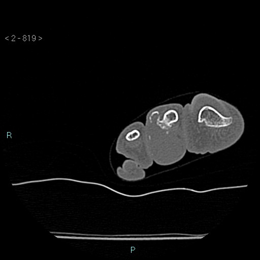 Chondrosarcoma - phalanx (Radiopaedia 69047-78812 Axial bone window 73).jpg