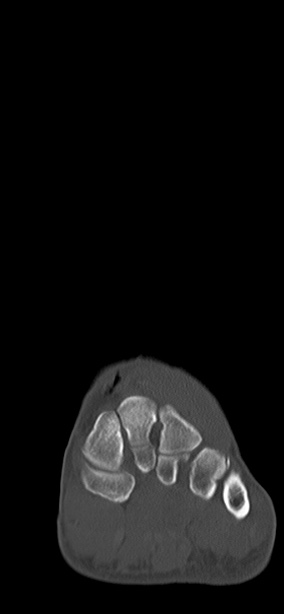 Chopart fracture (Radiopaedia 35347-36851 Coronal bone window 54).jpg