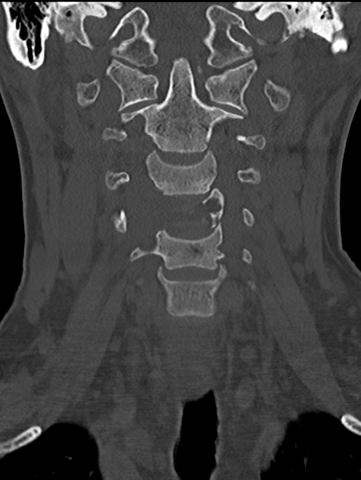 Chordoma (C4 vertebra) (Radiopaedia 47561-52188 Coronal bone window 17).png