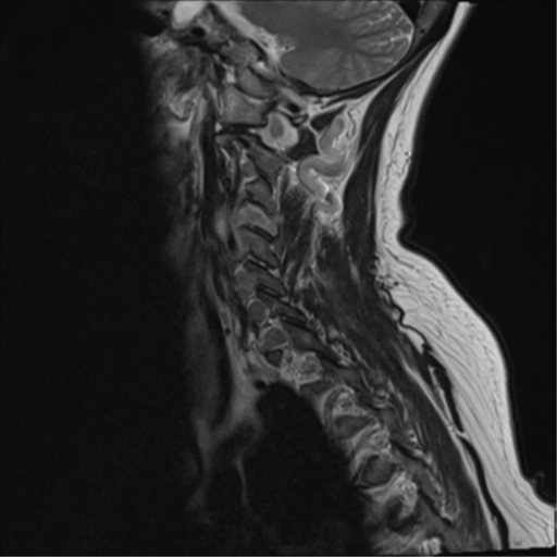 File:Chordoma (C4 vertebra) (Radiopaedia 47561-52189 Sagittal T2 12).png
