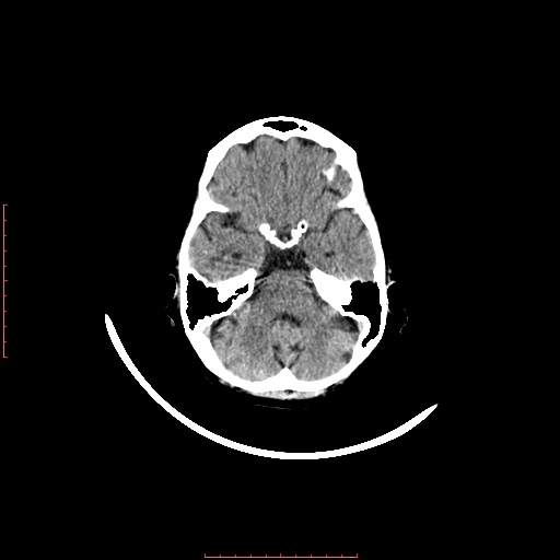 File:Choroid plexus xanthogranuloma (Radiopaedia 67843-77269 Axial non-contrast 14).jpg
