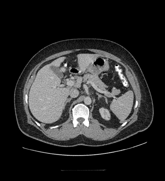 Chromophobe renal cell carcinoma (Radiopaedia 84337-99644 C 40).jpg