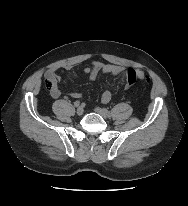 Chromophobe renal cell carcinoma (Radiopaedia 86879-103083 Axial non-contrast 88).jpg