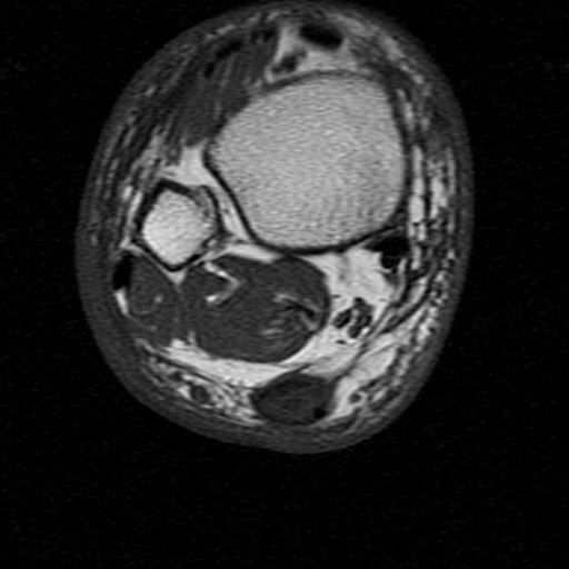 File:Chronic Achilles tendon rupture (Radiopaedia 15262-15100 Axial T1 6).jpg